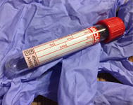 Informations sur le diagnostic en laboratoire de la maladie de Lyme Informations sur le diagnostic en laboratoire de la maladie de Lyme